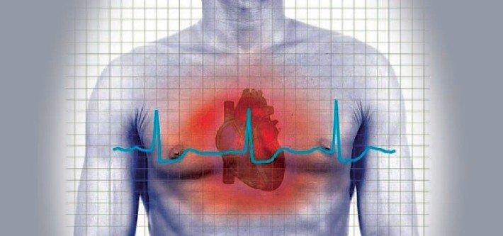 Cardiomiopatía