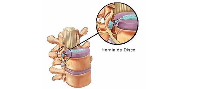 Hernia de disco