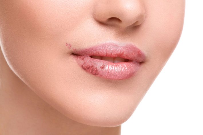 Soluciones para el herpes labial