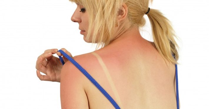 Melatonina para protegerse del sol