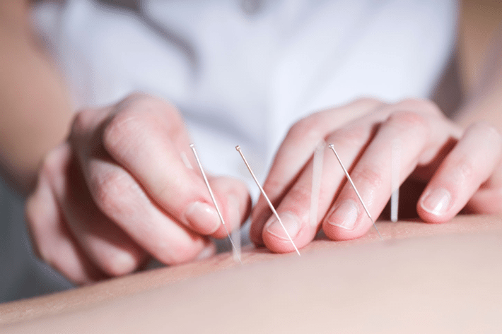 Acupuntura para aliviar el dolor