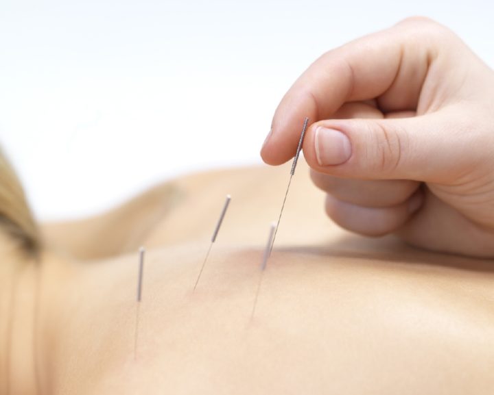 Electroacupuntura alivia el dolor