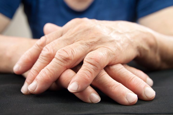 Efectos positivos de la niacina para síntomas de la artritis