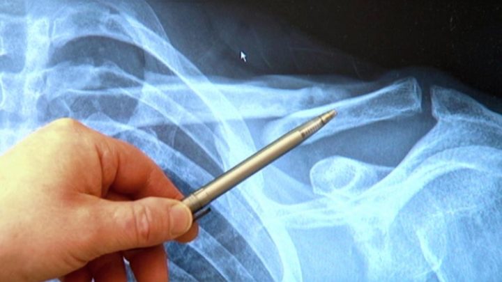 Tratamiento de fractura de clavícula en ciclismo