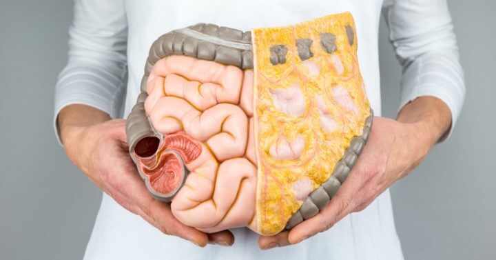 Síndrome del intestino permeable