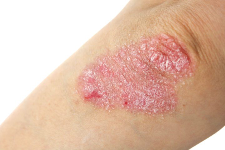 El aceite de árbol de té alivia la psoriasis