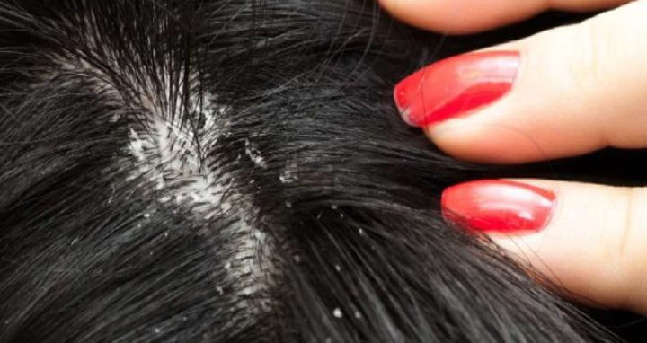 Causas de la caspa o dermatitis seborreica