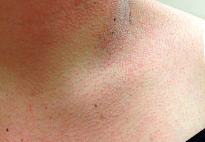 Causas de la queratosis pilaris o folicular