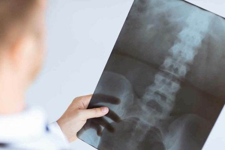 Estudios realizados de la osteoporosis