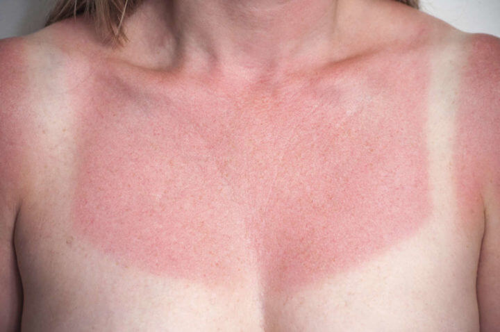 ¿Cómo tratar las quemaduras de sol?
