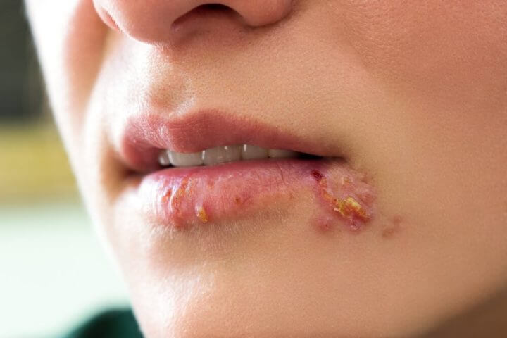 Cómo tratar el herpes