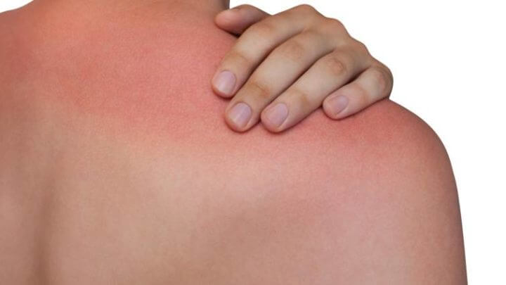 La falta de vitamina F puede causar alergias dermatológicas