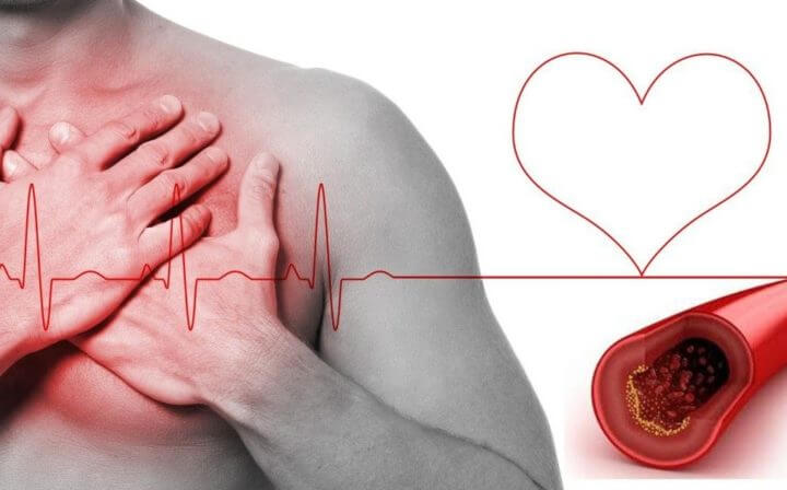 Cómo se acumula el colesterol en el cuerpo
