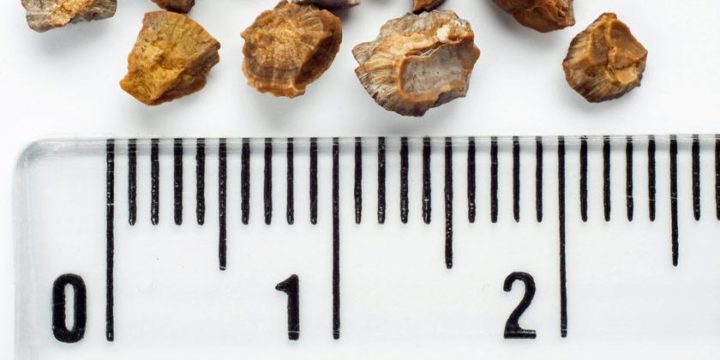 ¿Cómo se forman las piedras en el riñón?