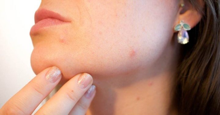 Acné como consecuencia de la mala salud intestinal