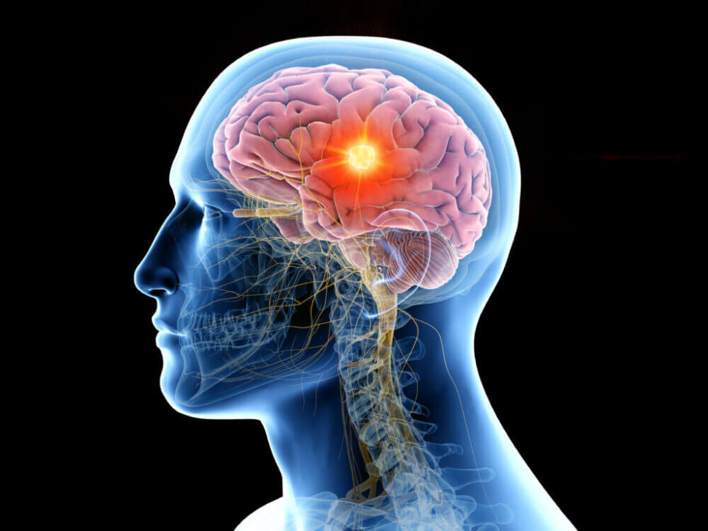 Así afecta a nuestro cerebro tener sobrepeso