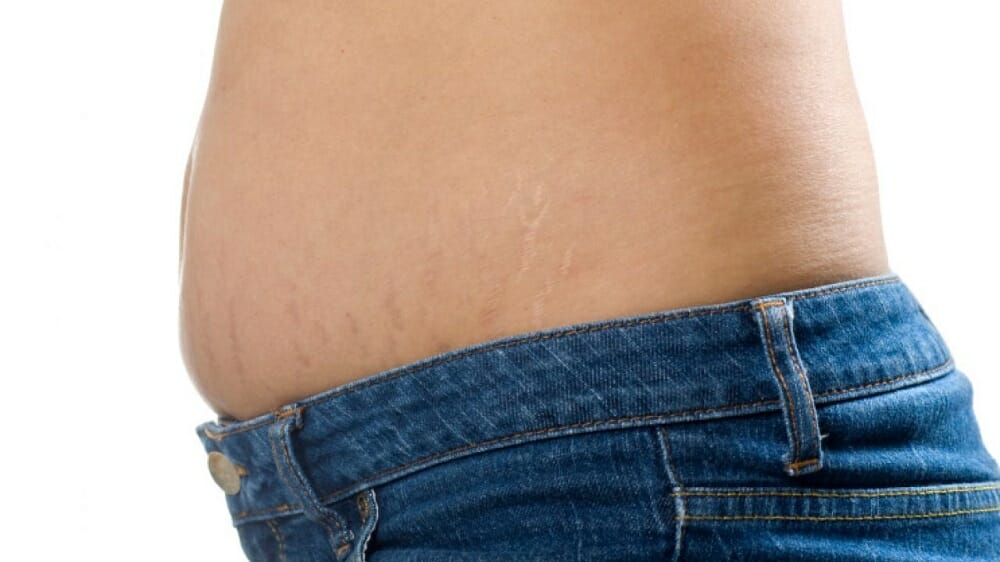 Aparición de estrías, cómo evitarlo