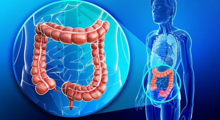 Evitar el cáncer colorrectal