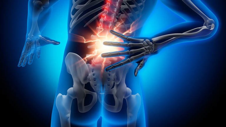 Ejercicio tras hernia discal