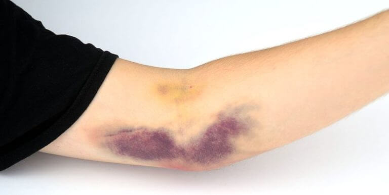 Motivos por los que aparecen hematomas con facilidad
