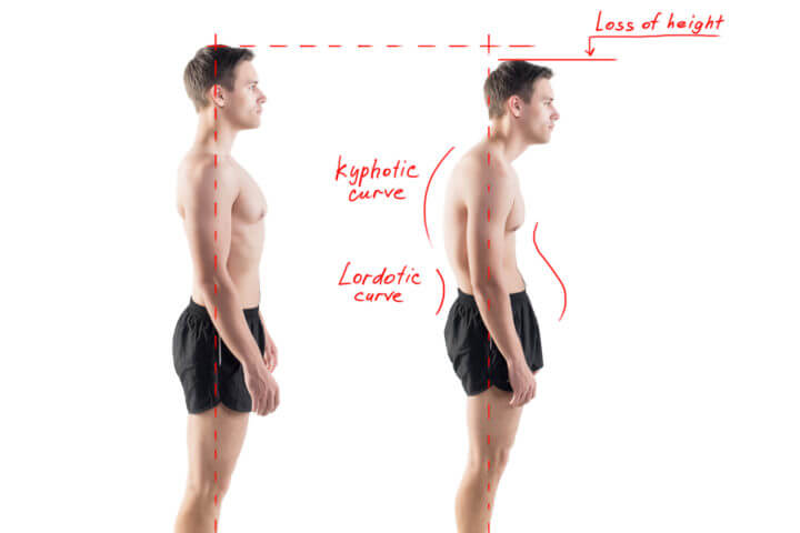 Las zonas del cuerpo que pueden ser afectadas por la mala postura