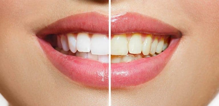 ¿Cómo blanquear tus dientes en casa?